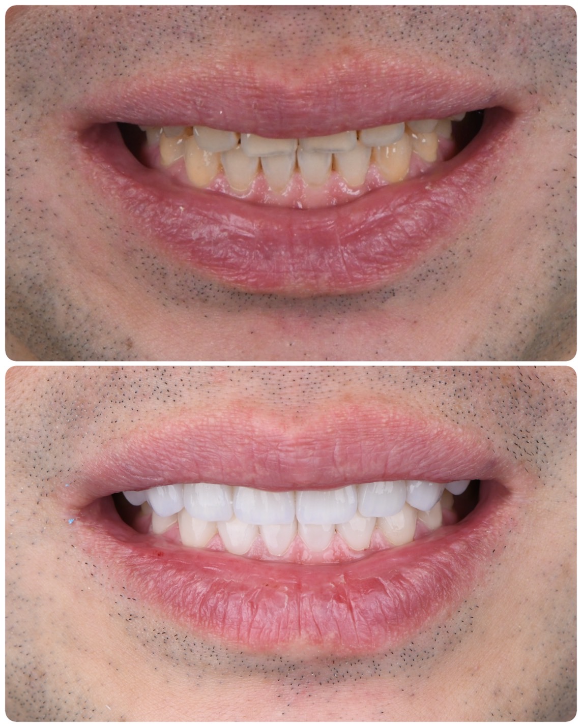 Before and After Case 9